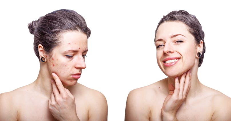 Skincare pelle acneica: consigli ed errori da evitare