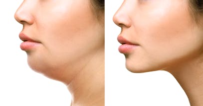 Come eliminare il doppio mento: esercizi e rimedi