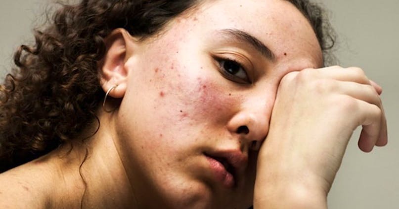 Beauty routine per la pelle impura: la skincare contro brufoli e imperfezioni