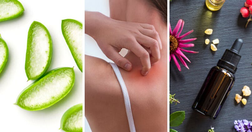 12 rimedi contro le punture di zanzare