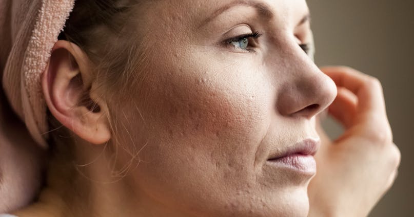 Skinace cicatrici acne e macchie: ecco come curarle