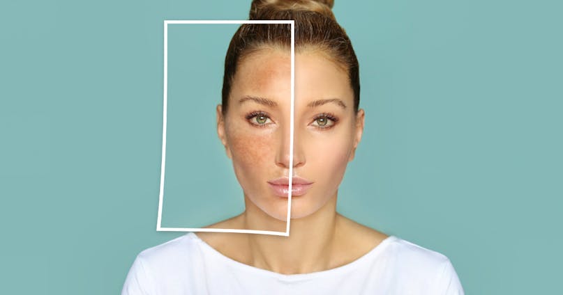 Macchie sulla pelle del viso: cause e rimedi